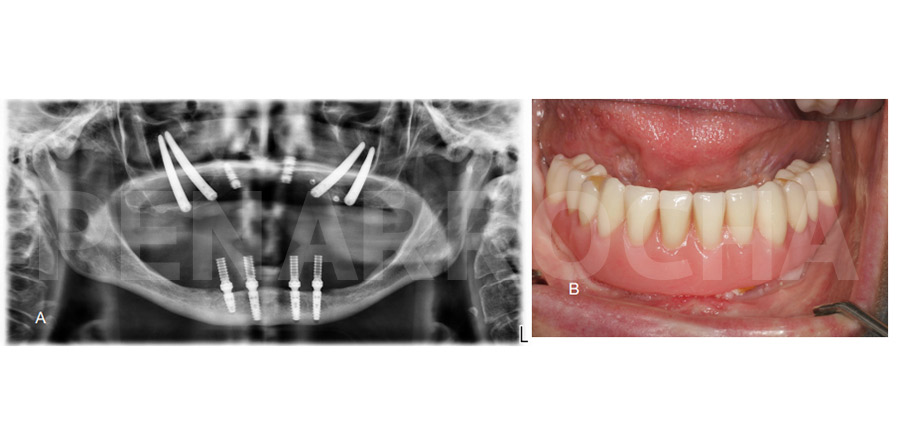 caso clinico implantes cigomaticos