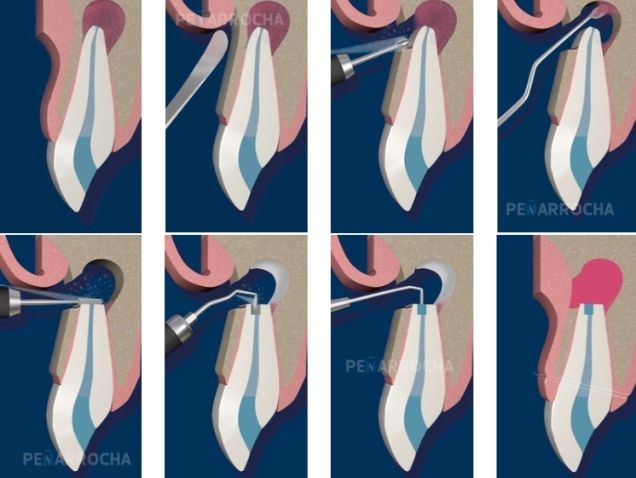 cirugia periapical en valencia tratamiento para conservar diente natural