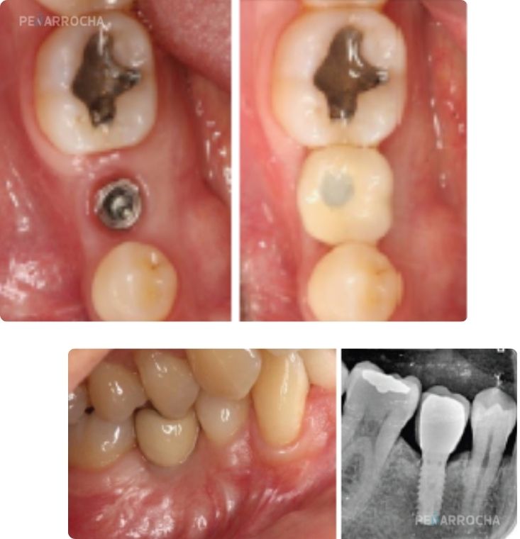 evolucion favorable tras tratamiento infeccion en implantes