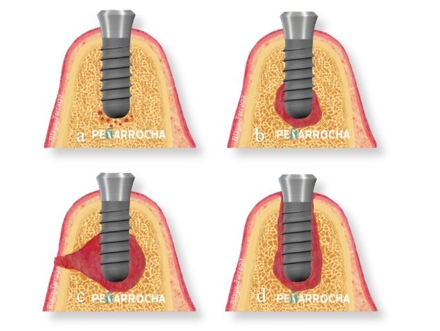 fracaso de implantes dentales infeccion en implante