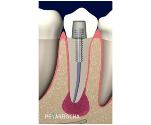 infeccion de implantes periimplantitis periapical aguda