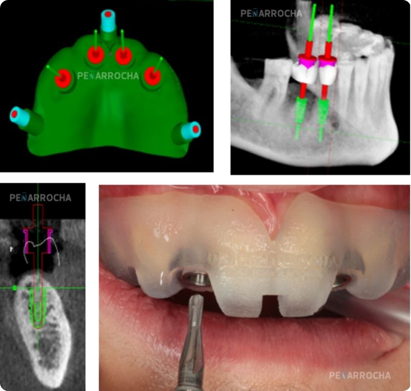 ventajas cirugia guiada en implantes dentales